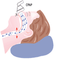respirazione facilitata con CPAP